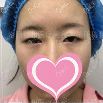 手術(shù)前眼睛小而無神 手術(shù)前眼睛小而無神