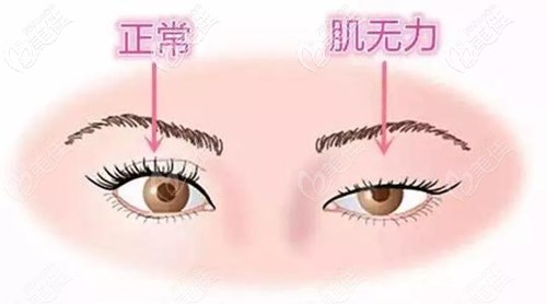 雙眼皮和上下下垂的區(qū)別 雙眼皮和上下下垂的區(qū)別