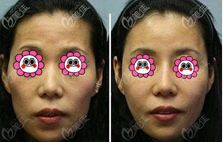 張讓虎脂肪填充全臉案例