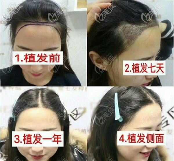 女士發(fā)際線調(diào)整1年后的效果圖