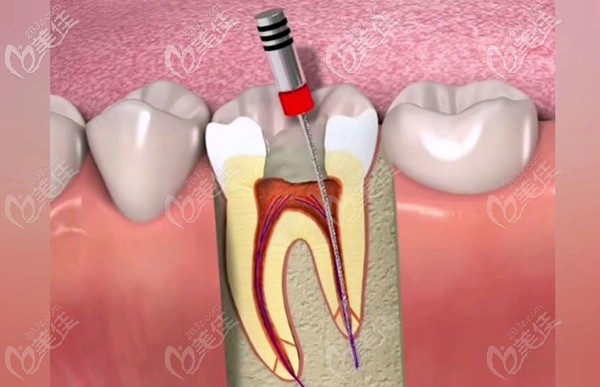 醫(yī)院口腔科拔牙補牙價格 醫(yī)院口腔科拔牙補牙價格