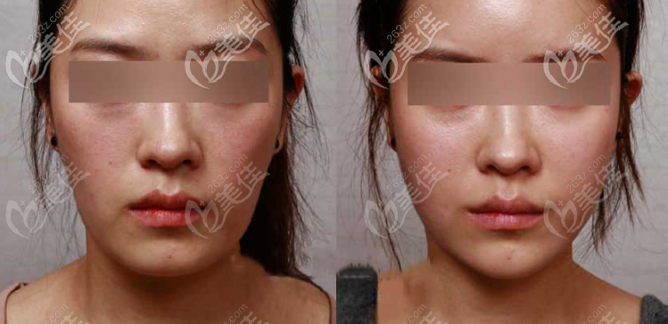 北京自體脂肪全臉填充效果圖
