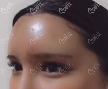 脂肪填充過量導(dǎo)致壽星公