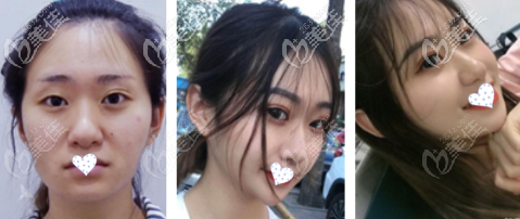 成功的全臉脂肪填充效果圖