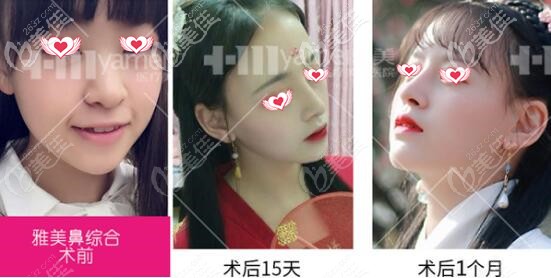 長(zhǎng)沙雅美鼻綜合真人案例