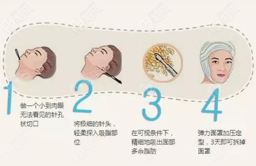 面部吸脂手術(shù)
