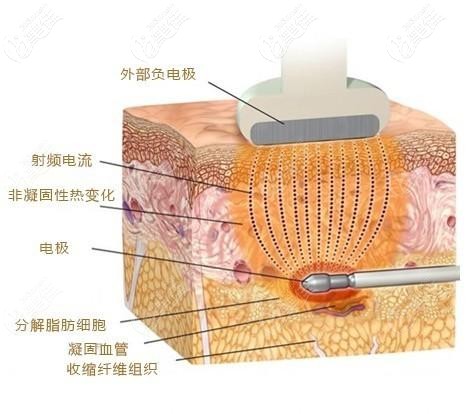 面部黃金微雕原理