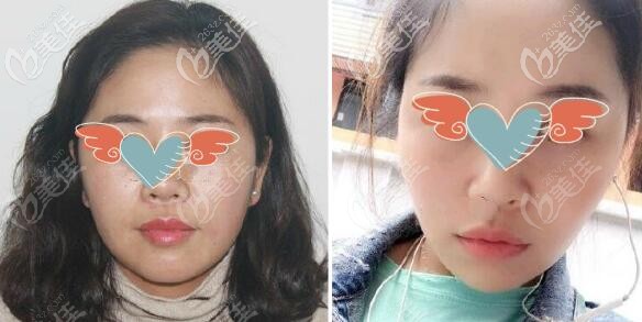 面部歐薇拉提升三個(gè)月效果圖片 面部歐薇拉提升三個(gè)月效果圖片