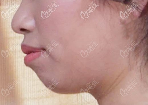 矯正前的側面照 矯正前的側面照