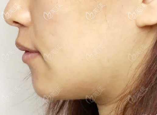 在口腔矯正齙牙齒后,凸嘴臉型也被正畸給改善了~