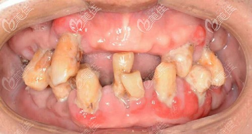 做牙齒修復(fù)前的情況 做牙齒修復(fù)前的情況