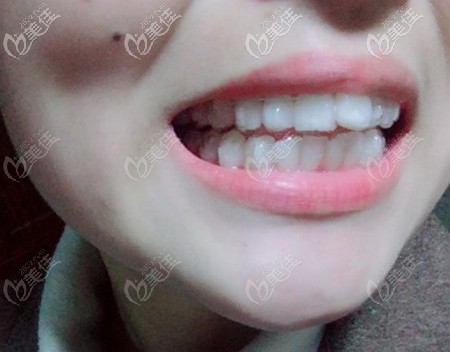 戴時代天使隱形牙套后的療效