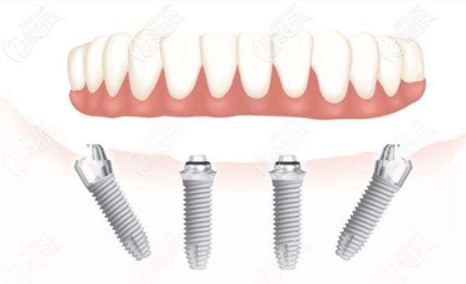 ALL-ON-4種植技術 ALL-ON-4種植技術