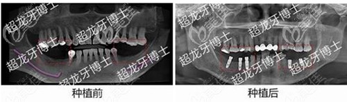 長春超龍牙博士種植牙案例