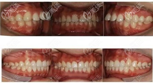 長春超龍牙博士金屬牙齒矯正案例