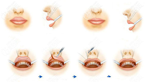 厚唇改薄切的不美觀導(dǎo)致后悔