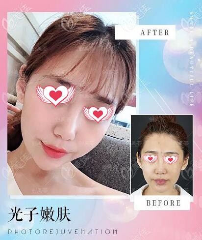 薈醫(yī)療美容光子嫩膚真人對比照