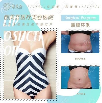 薈醫(yī)療美容腰腹環(huán)吸真人案例對比照