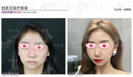 薈醫(yī)療美容敏感肌修復真實對比