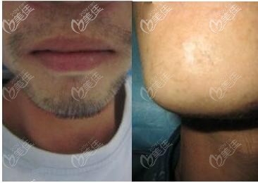 男士絡腮胡做月光真空脫毛案例效果圖片