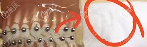 球面自鎖托槽不磨嘴