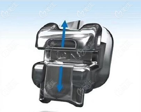 美國(guó)damon方形自鎖托槽的優(yōu)勢(shì)