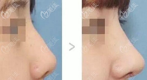 全肋骨隆鼻前后效果對(duì)比