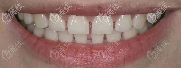 門牙牙縫2mm大做了emax牙貼面 門牙牙縫2mm大做了emax牙貼面