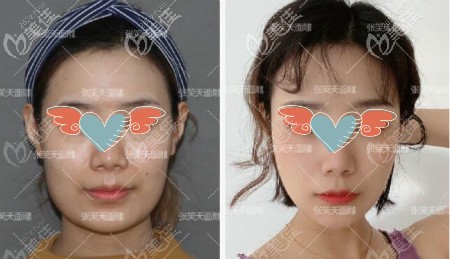 北京圣嘉新張笑天醫(yī)生下頜角磨骨案例效果 北京圣嘉新張笑天醫(yī)生下頜角磨骨案例效果