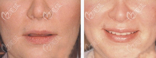 輕度微笑時前牙切端是否顯露 輕度微笑時前牙切端是否顯露