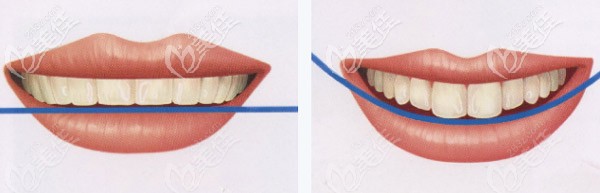 上門牙是否稍微長過兩側(cè)鄰牙 上門牙是否稍微長過兩側(cè)鄰牙