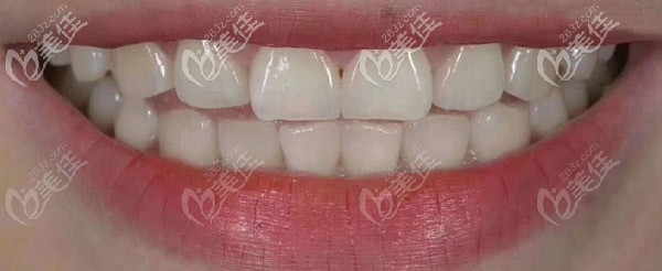 門牙牙縫2mm大我在馬龍齒科萬象城店做了12顆德國E-max超薄瓷貼面