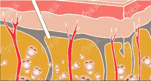 大腿吸脂手術原理