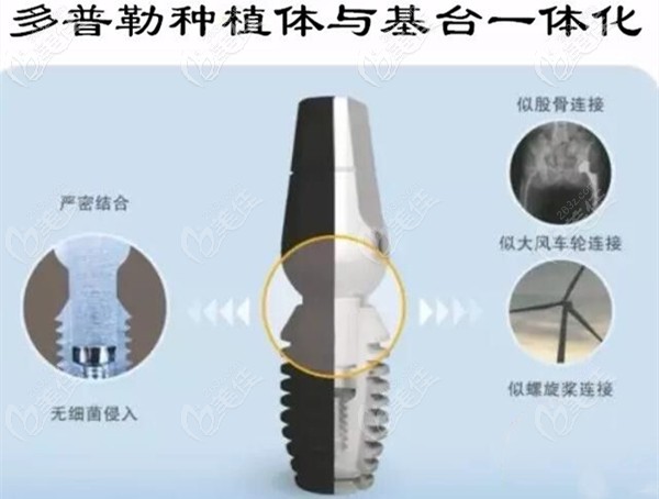 韓國duplo多普勒種植體