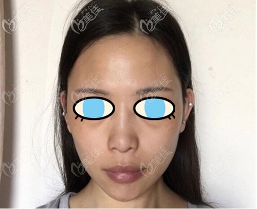 術(shù)前照片 術(shù)前照片