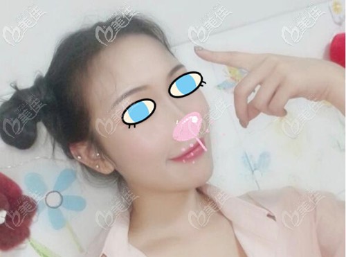 歐洲之星Fotona 4D去法令紋體驗(yàn):這效果你還能看出我35歲嗎？