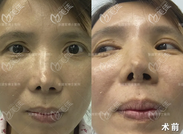 找廣州張建軍醫(yī)生做仿生理雨沙鼻修復(fù)術(shù)前 找廣州張建軍醫(yī)生做仿生理雨沙鼻修復(fù)術(shù)前