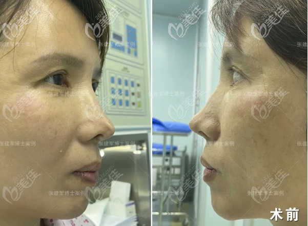 隆鼻失敗術(shù)前側(cè)面照片 隆鼻失敗術(shù)前側(cè)面照片