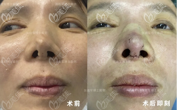 廣州張建軍醫(yī)生仿生理雨沙鼻修復(fù)案例 廣州張建軍醫(yī)生仿生理雨沙鼻修復(fù)案例