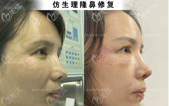 廣州張建軍醫(yī)生仿生理雨沙鼻修復(fù)案例,效果自然不說(shuō)也沒(méi)有后遺癥