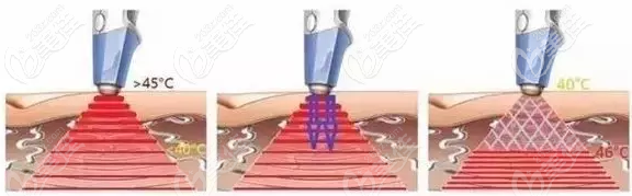 btl射頻原理示意圖 btl射頻原理示意圖
