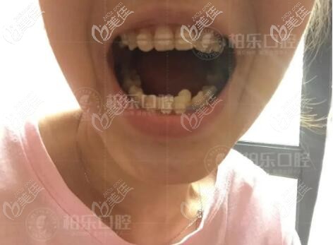 南寧柏樂口腔正畸把案例 南寧柏樂口腔正畸把案例