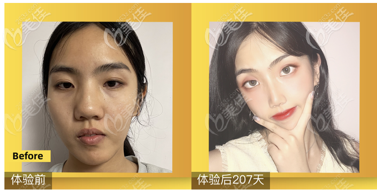 <!--<i data=20240703-sp></i>-->鄒進進醫(yī)生膨體隆鼻案例效果圖