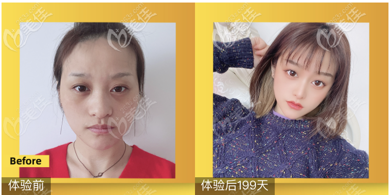 <!--<i data=20240703-sp></i>-->醫(yī)院鄒進進醫(yī)生假體隆鼻案例