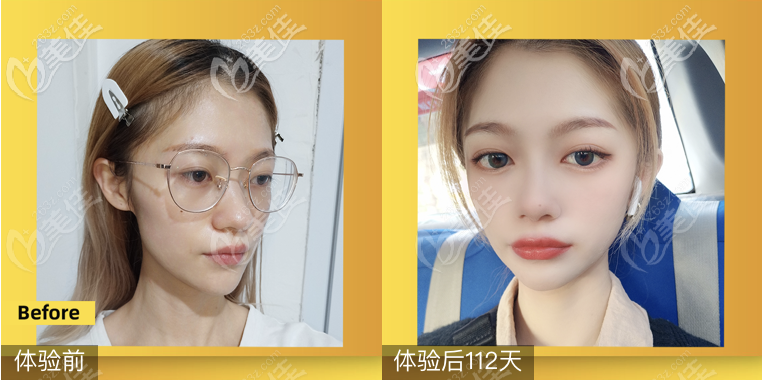 <!--<i data=20240703-sp></i>-->鄒進進隆鼻技術(shù)怎么樣