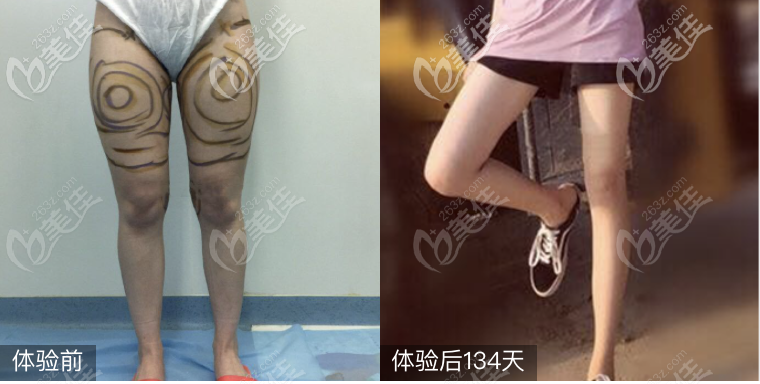 <!--<i data=20240703-sp></i>-->整形醫(yī)院袁野醫(yī)生吸脂案例 <!--<i data=20240703-sp></i>-->整形醫(yī)院袁野醫(yī)生吸脂案例