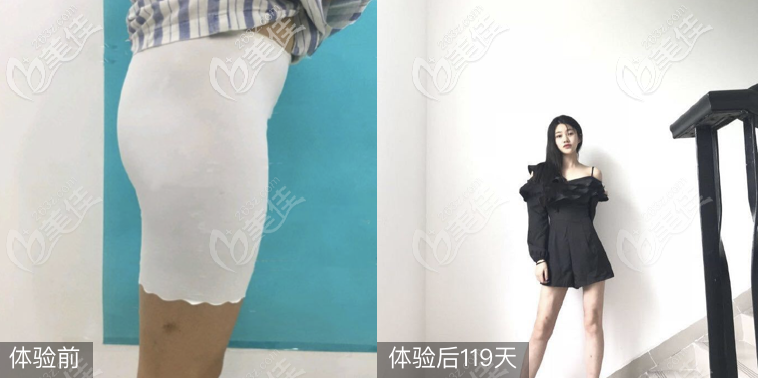 <!--<i data=20240703-sp></i>-->整形醫(yī)院袁野抽脂技術(shù)怎么樣 <!--<i data=20240703-sp></i>-->整形醫(yī)院袁野抽脂技術(shù)怎么樣