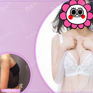 蘇州康美隆胸案例