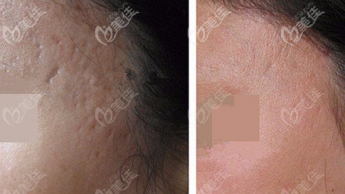 CO2點陣激光去疤案例圖