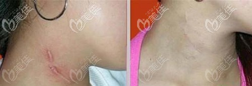 plasma祛疤效果圖